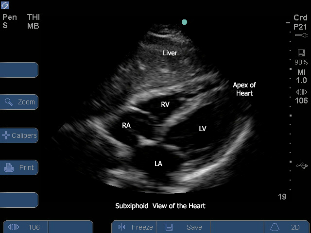 Sonosite subcostal view