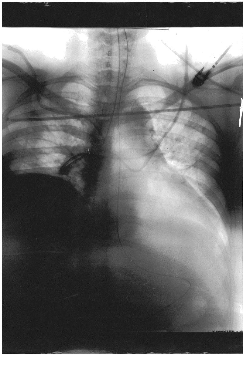 CXR