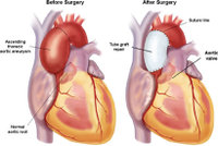 Aortic_arch_dissection_diagram