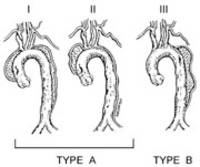 Aortic_dissection_fig1_2